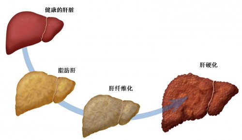 脂肪肝